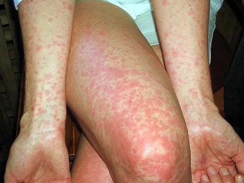 همه چیز درباره حصبه (تیفوئید)