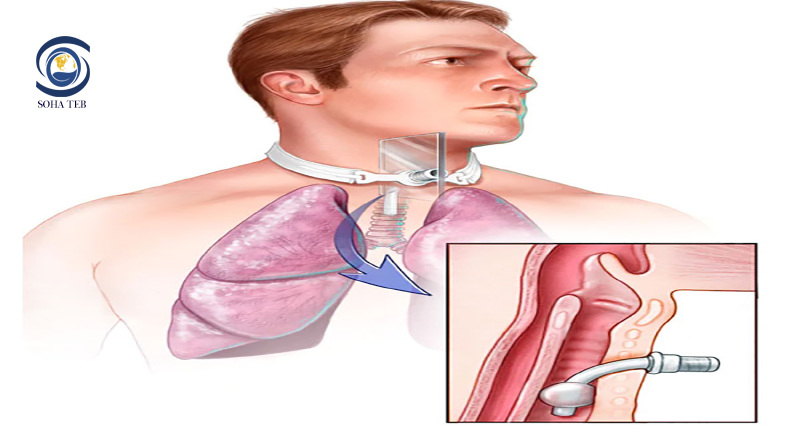 تعویض تراکئوستومی در منزل