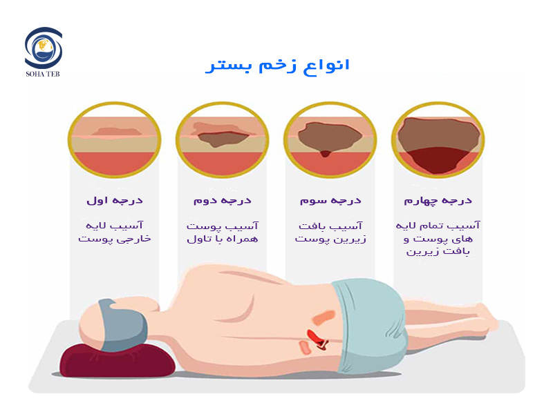درمان زخم بستر در منزل